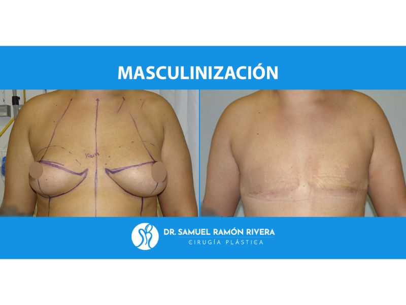 mastectomia trans precio