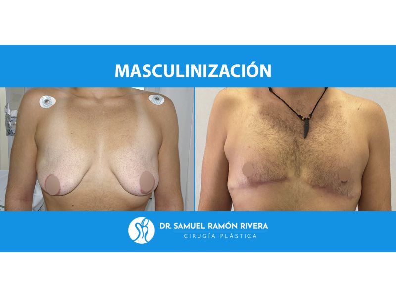 clinicas mastectomia trans