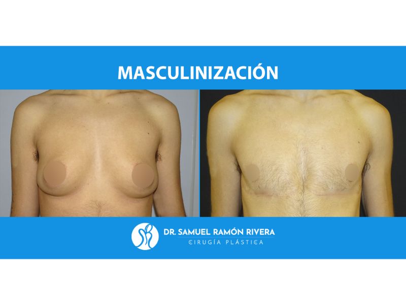 mastectomia trans cirujano especialista