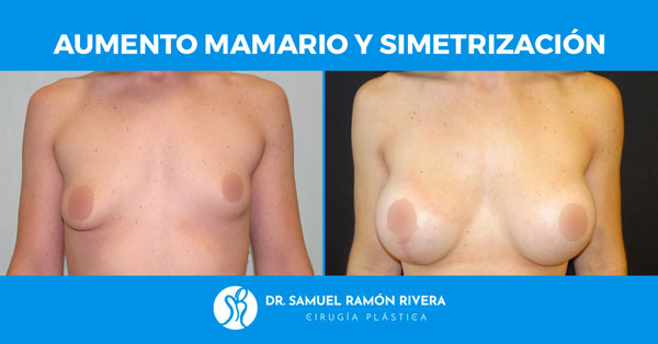 simetrizacion-mamas-antes-despues