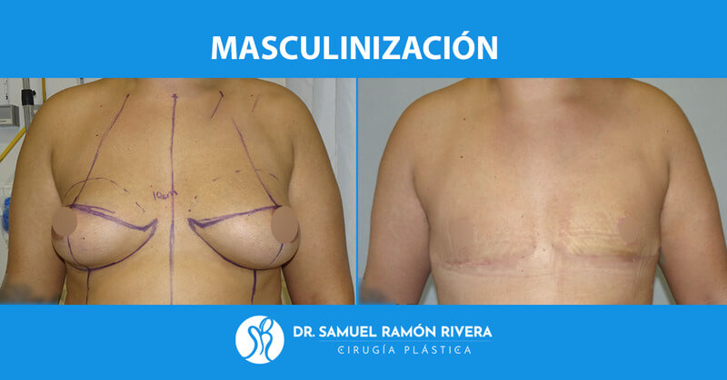1frontal-antes-despues-mastectomia-trans