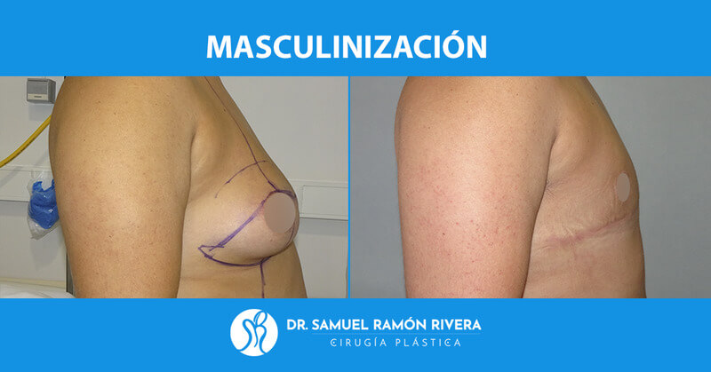1perfil-antes-despues-mastectomia-trans