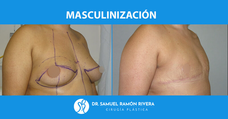 1semiperfil-antes-despues-mastectomia-trans