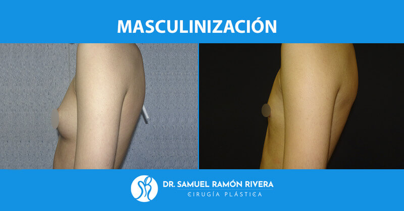2-perfil-despues-mastectomia-trans