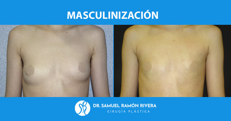 2frontal-despues-mastectomia-trans