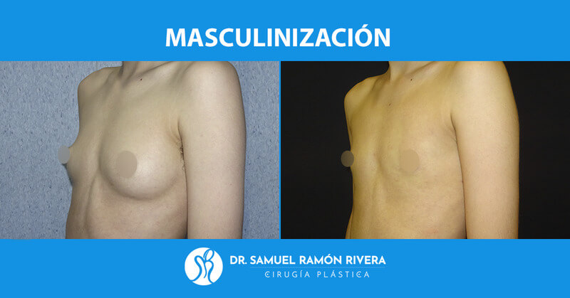 2semipefil-despues-mastectomia-trans