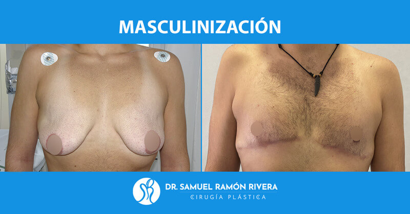 3frontal-despues-mastectomia-trans