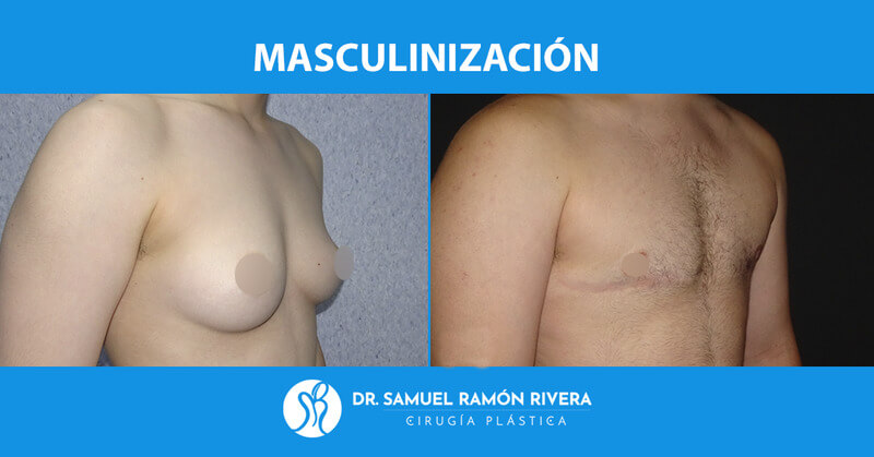 5semiperfil-despues-mastectomia-trans