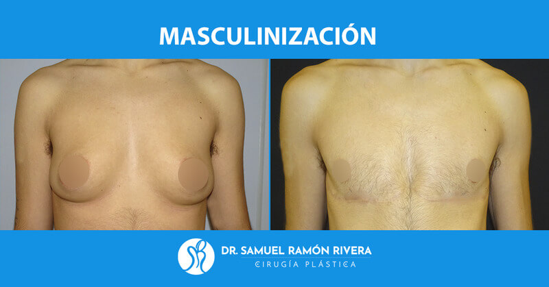 4frontal-despues-mastectomia-trans.jpg
