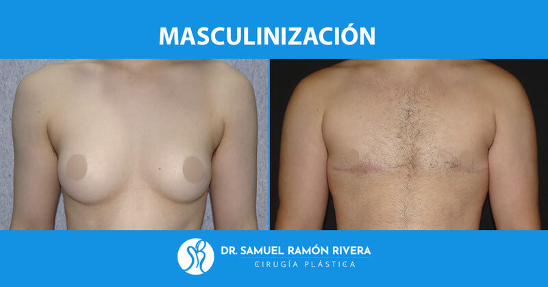 5frontal-despues-mastectomia-trans.jpg