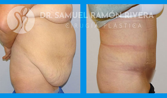 abdominoplastia antes y depsues doctor samuel ramon