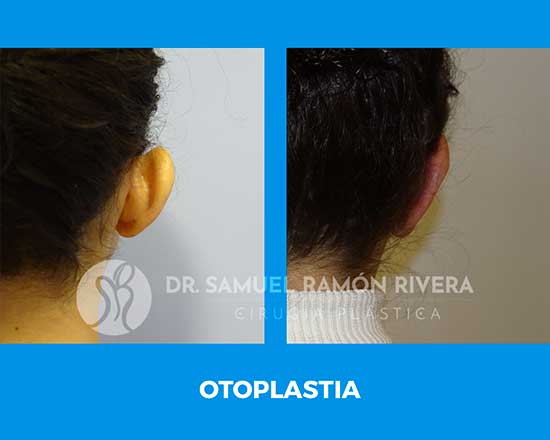 especialista en otoplastia