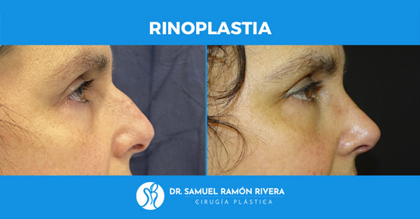 operacion-rinoplastia-resultados-2.jpg