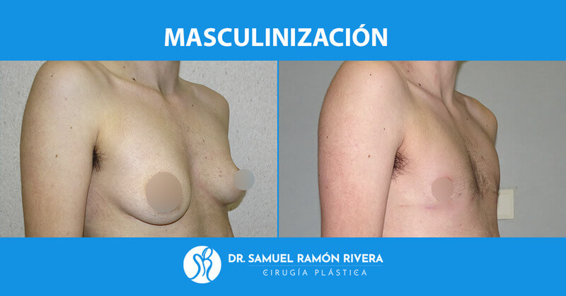 resultados mastectomia